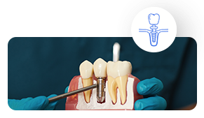 https://globaldental.web.boundlesstechnologies.net/wp-content/uploads/2025/09/Dental-Implants.png